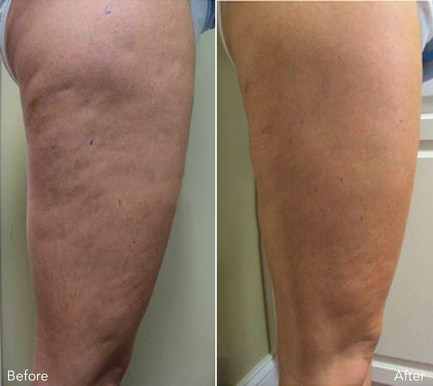 Ultimate cellulite treatment before and after